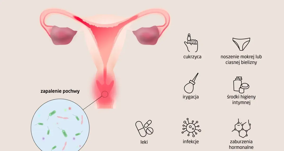 Ilustracja przedstawia przyczyny zapalenia pochwy, w tym infekcje, cukrzycę i zaburzenia hormonalne.