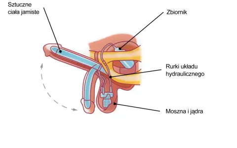 Schemat protezy penisa, która umożliwia erekcję dzięki hydraulicznemu układowi.
