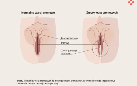 Ilustracja pokazuje, jak wygląda cipa: normalne wargi sromowe i zrośnięte wargi sromowe, które mogą częściowo lub całkowicie zamykać wejście do pochwy.