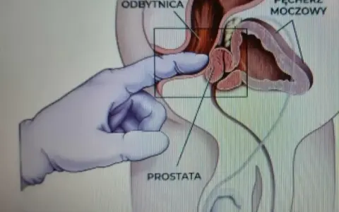 Ilustracja medyczna przedstawiająca palec w rękawiczce wykonujący masaż prostaty przez odbytnicę.