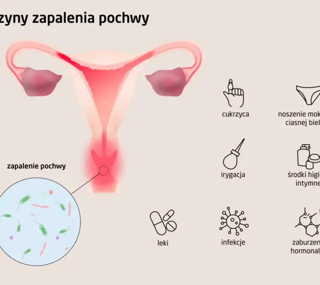 Ilustracja przedstawia przyczyny zapalenia pochwy, w tym infekcje, cukrzycę i zaburzenia hormonalne.